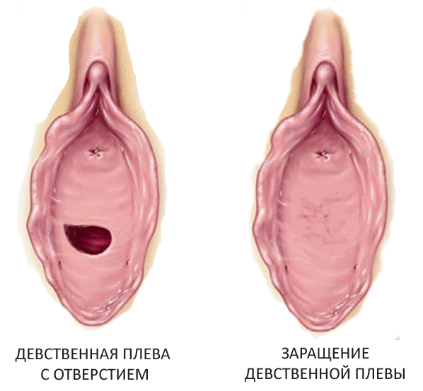 Заращение девственной плевы - гинатрезия, что это такое