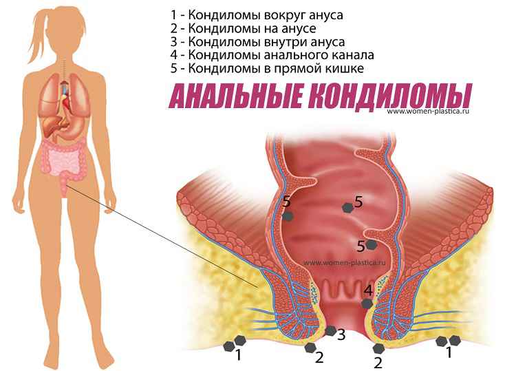 Удаление папиллом в заднем проходе скальпелем восстановление 34