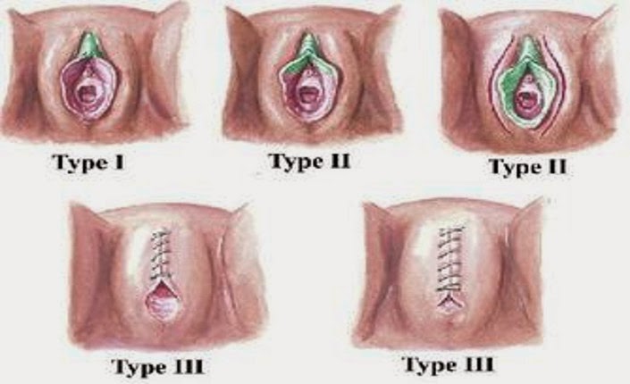 Разновидности операции по удалению гениталий