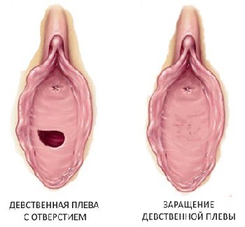 плева девочка Девственная плева — Википедия
